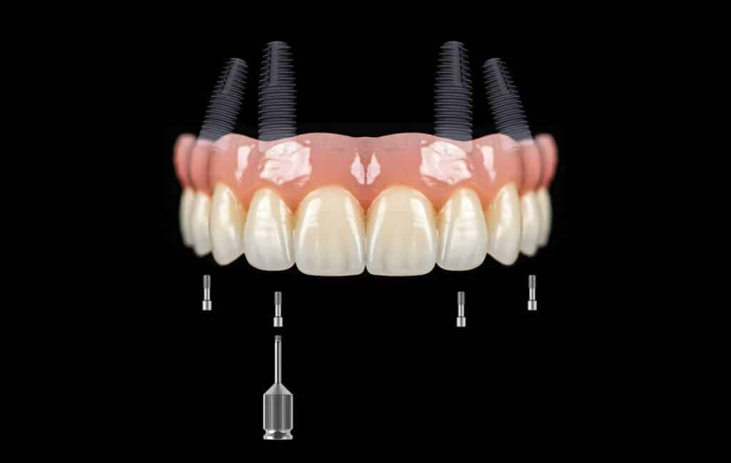 all on 4 dental implants plano