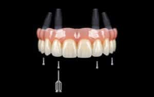 all on 4 dental implants plano