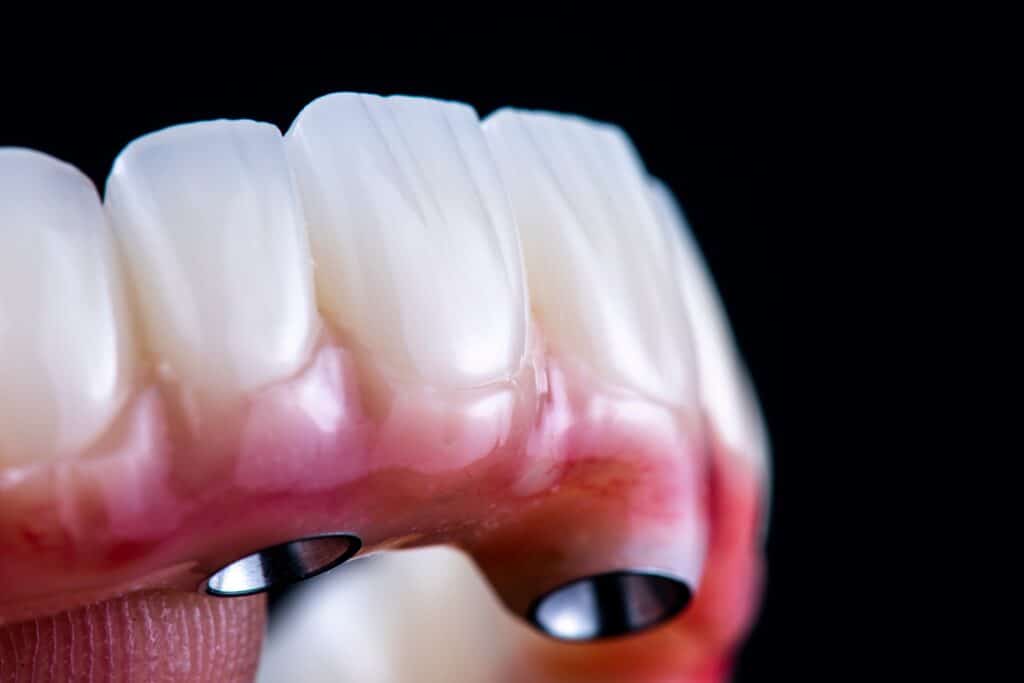 Implant-Supported Bridges plano