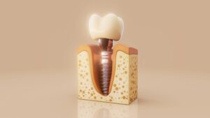 dental implants in plano tx