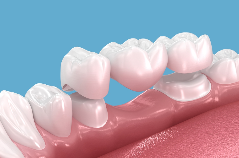 Dental crowns plano